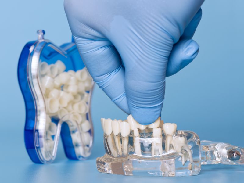 Dental Bridges Near Me