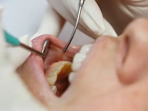 Affordable Laser Dentistry