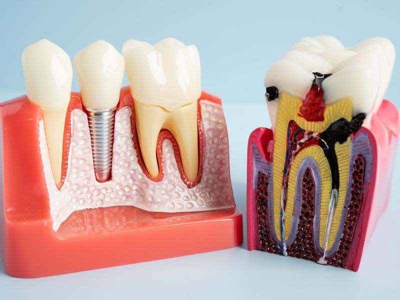 Endodontists in Brambleton