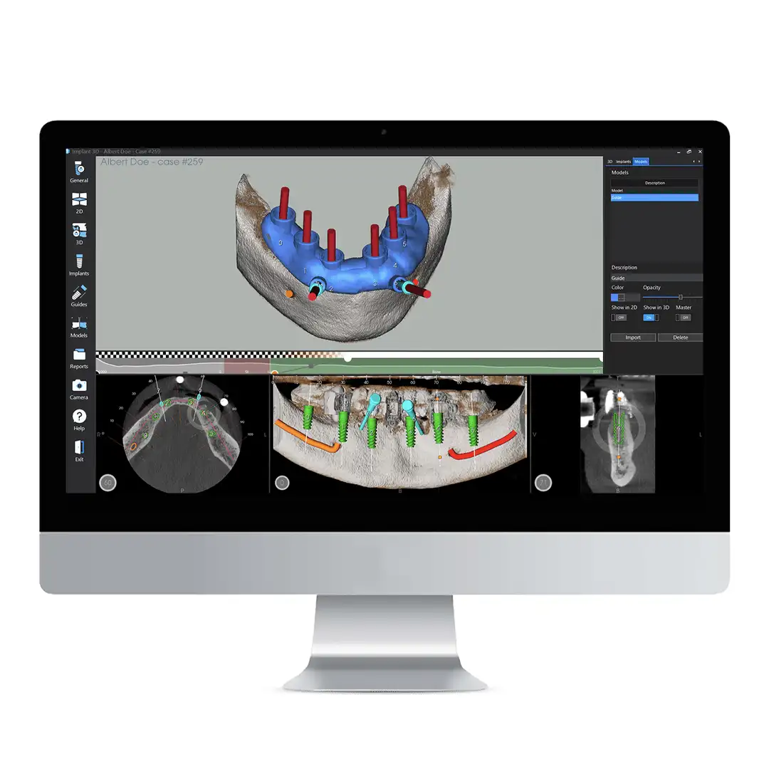 Implant 3D Guides