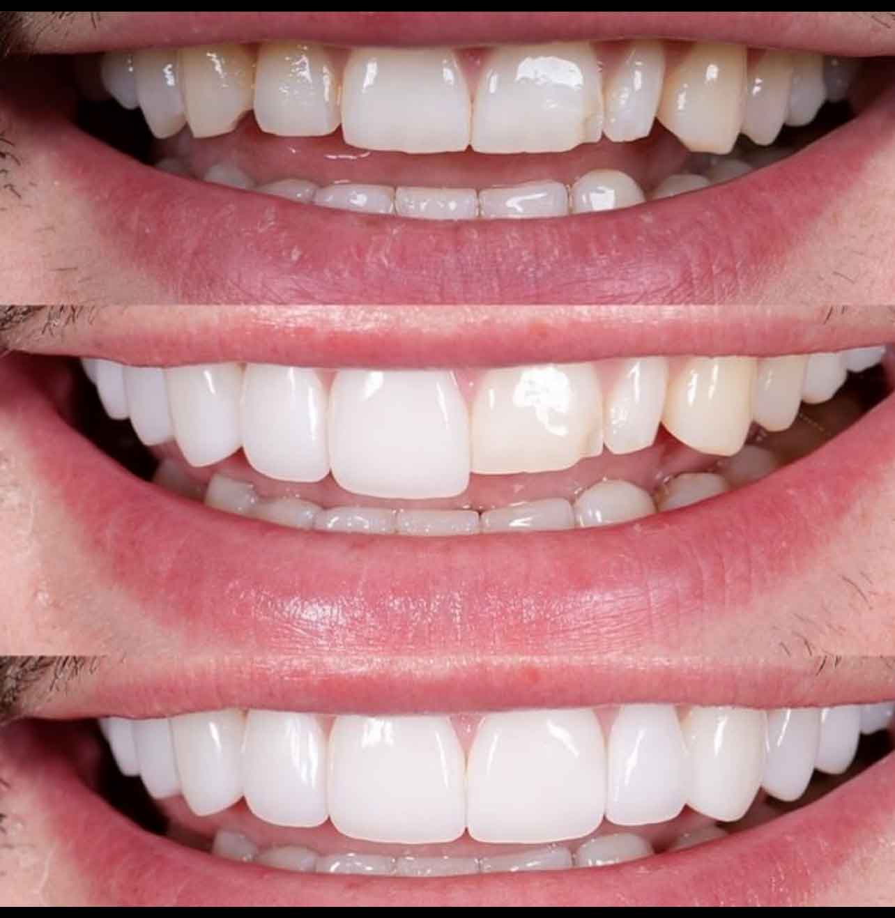 Brambleton Invisalign Dentist