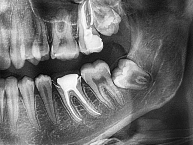 Wisdom Teeth Extraction Near Me